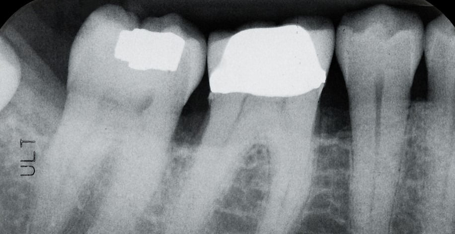 Safety measures taken to minimize radiation during dental x-rays