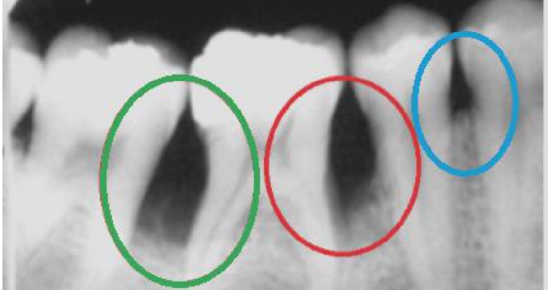 Dental X-Rays