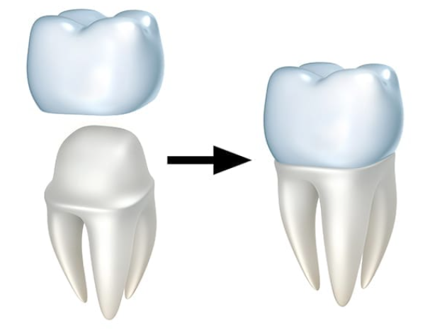 Post Crown Preparation and Cementation