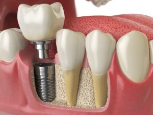 available options for teeth replacement