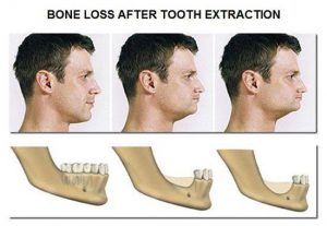 benefits of replacing missing teeth