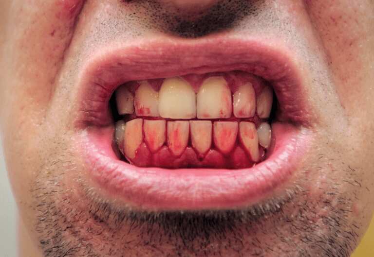 Bleeding Gums 