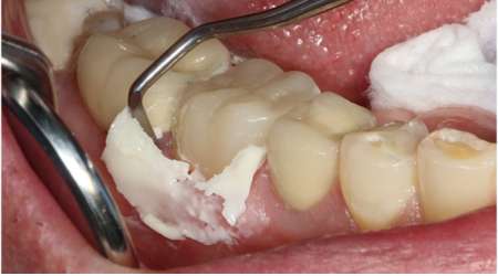 Cementation of the final fixed bridge