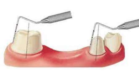 Preparation of abutment tooth