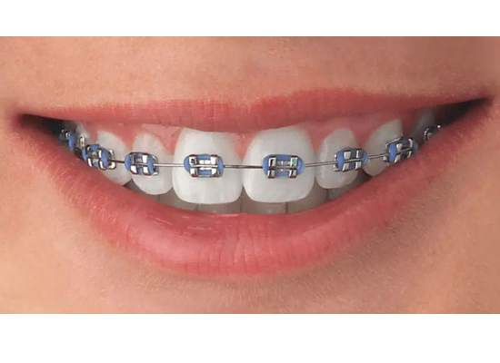 Conventional metal braces