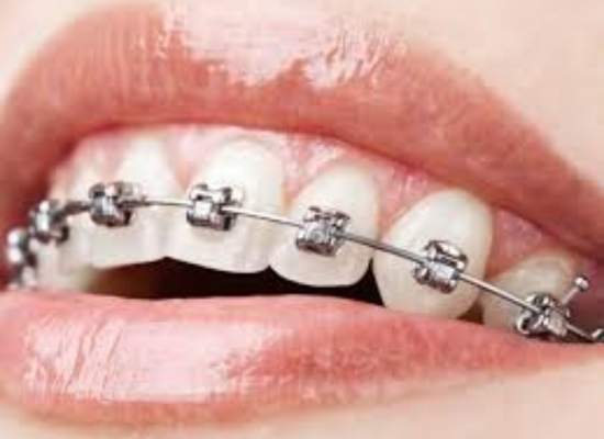 Damon metal braces