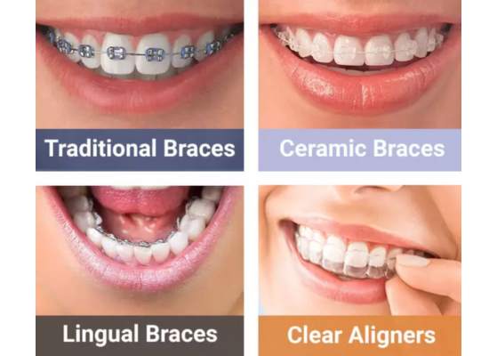 Types of Braces