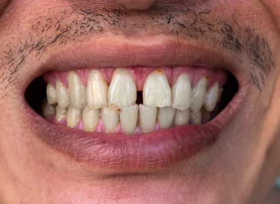 gaps between your teeth